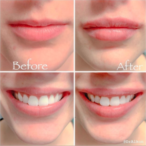 Restylane & Botox Lip Fillers Patient 3 | Joseph D Alkon MD